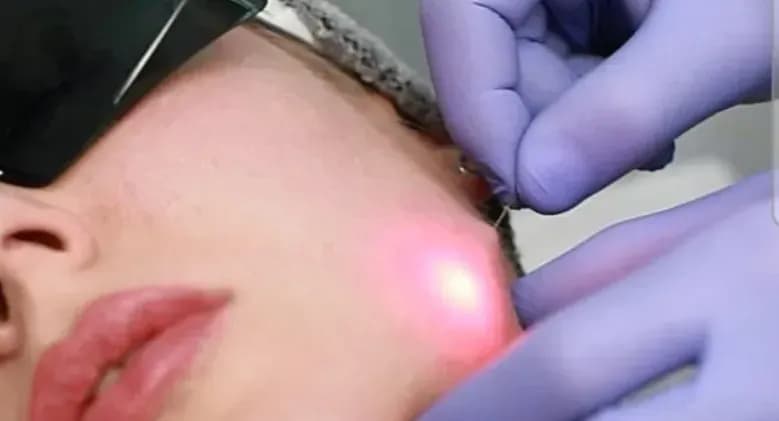 Endolift