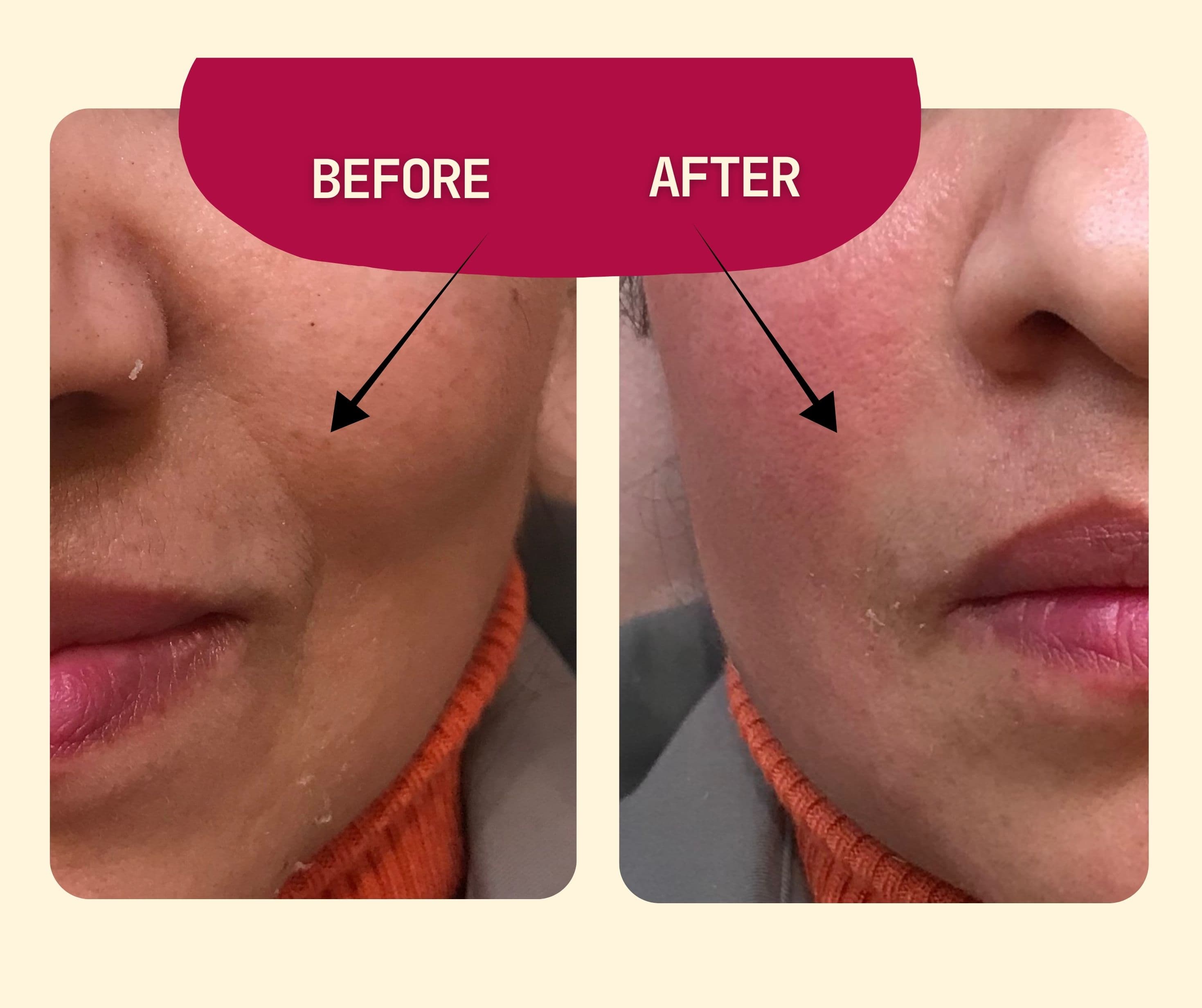 Before and After Nasolabial Fold