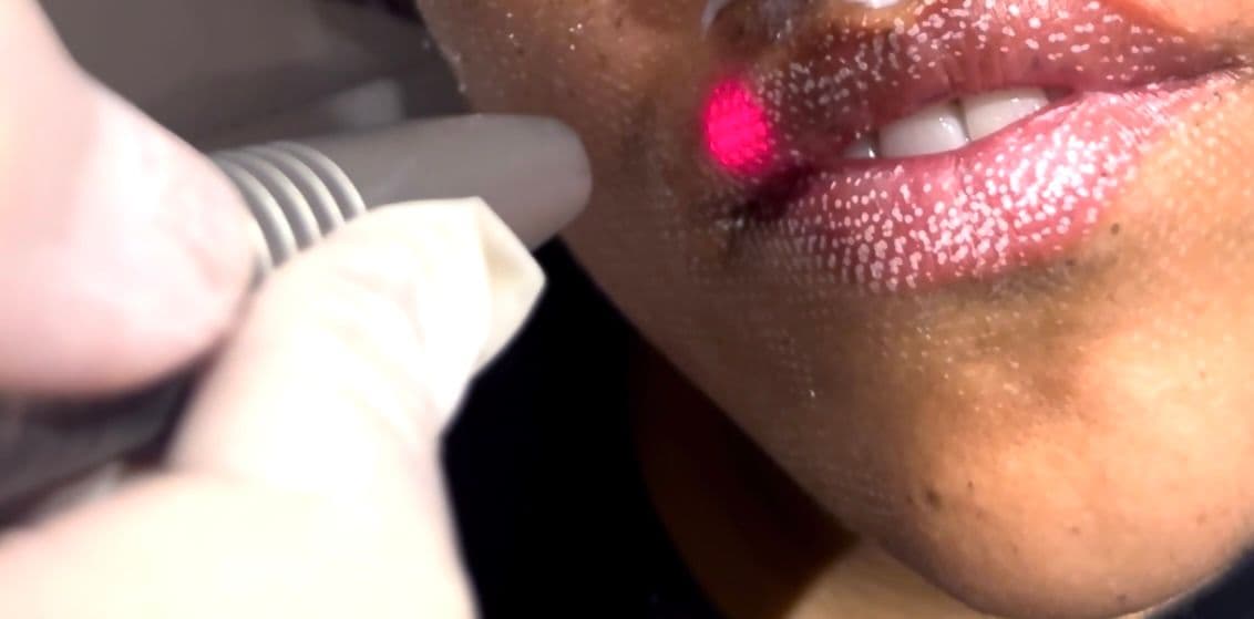 Liplase Laser
