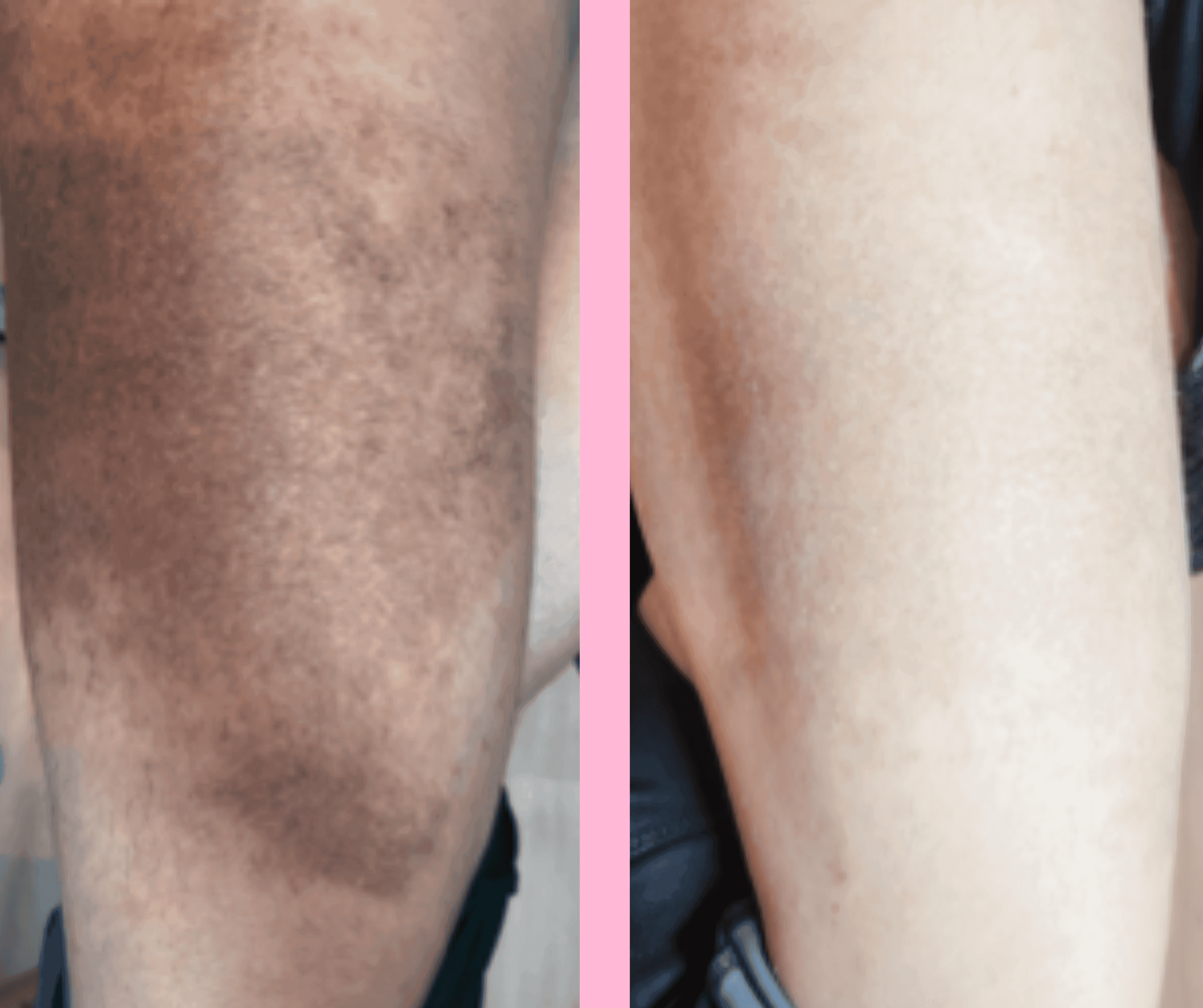 Before and After Hyper-pigmentation Treatment