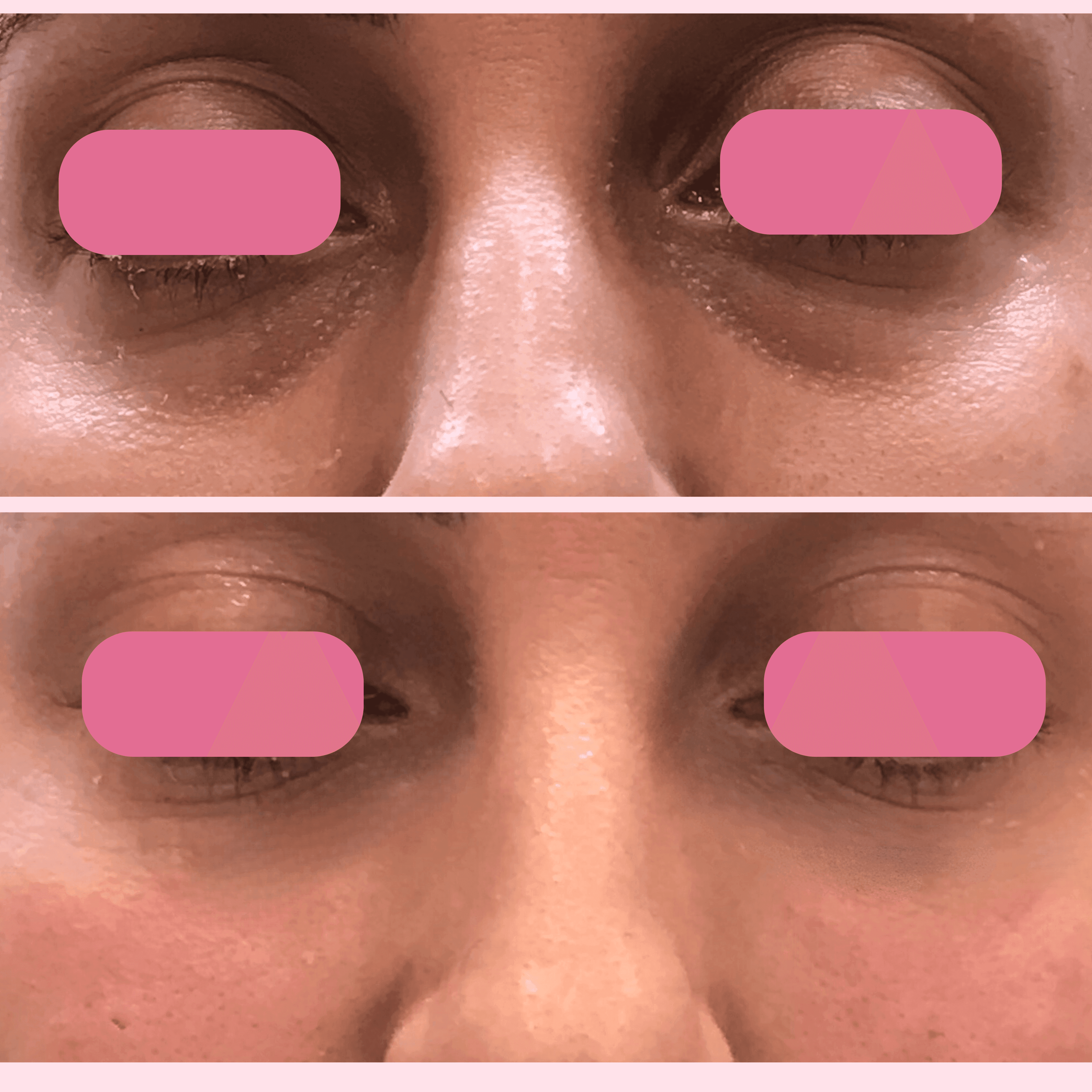 Before and After Under Eye Filler