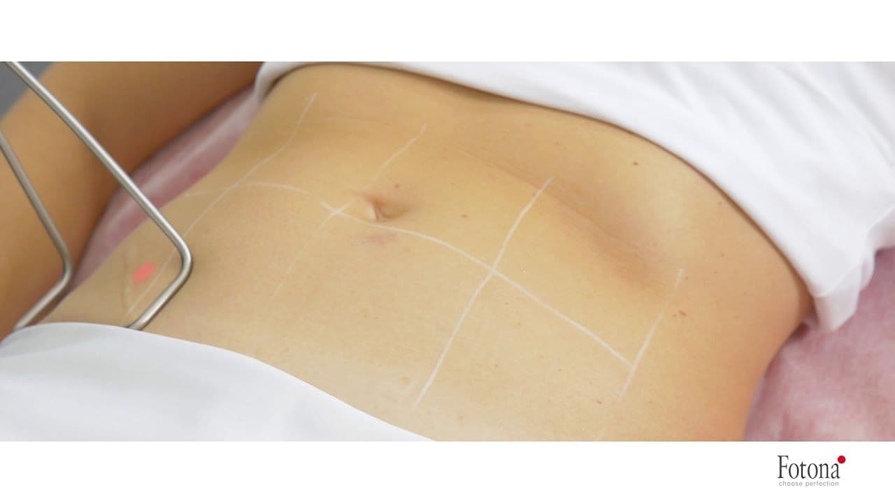 TightSculpting