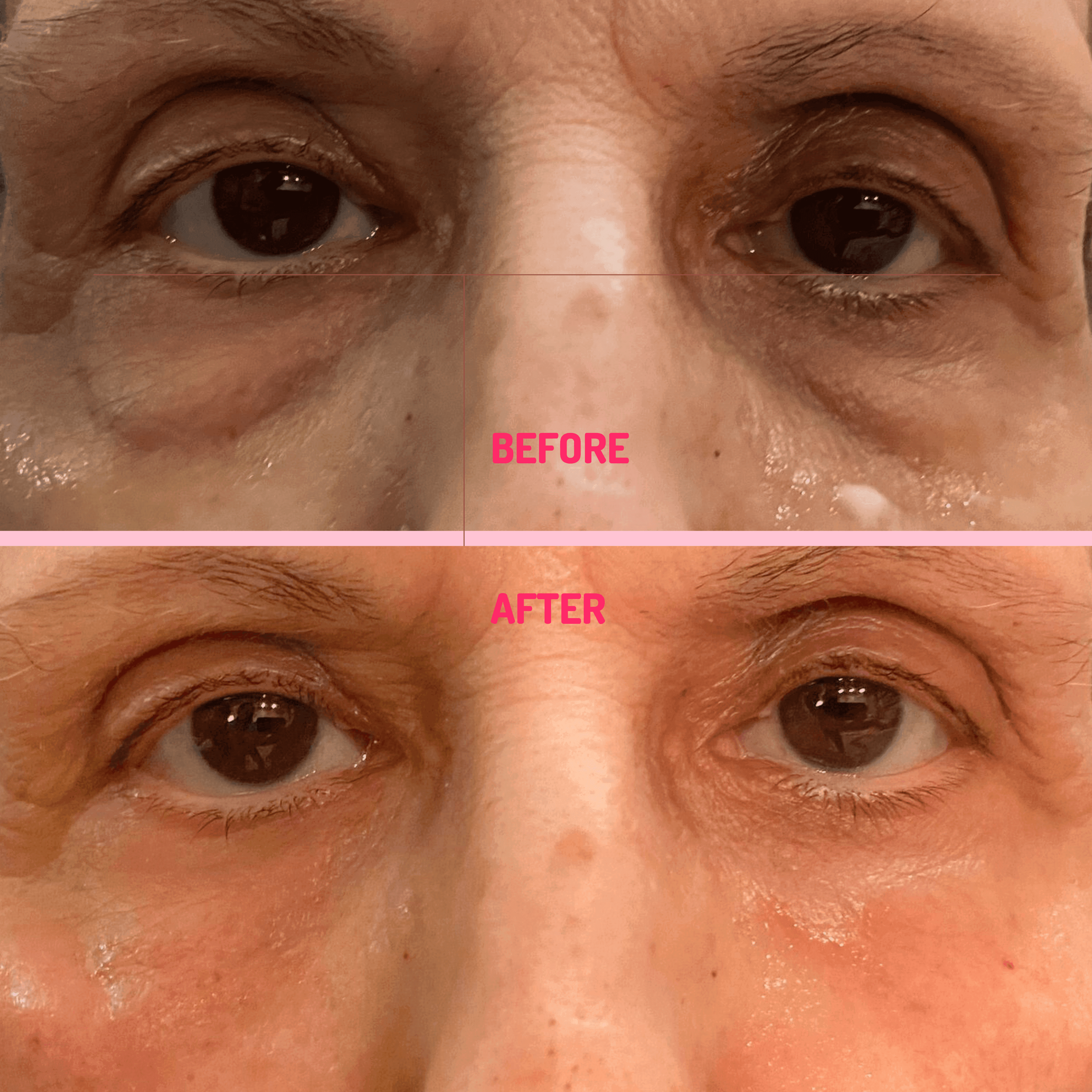 Before and After Smooth Eye