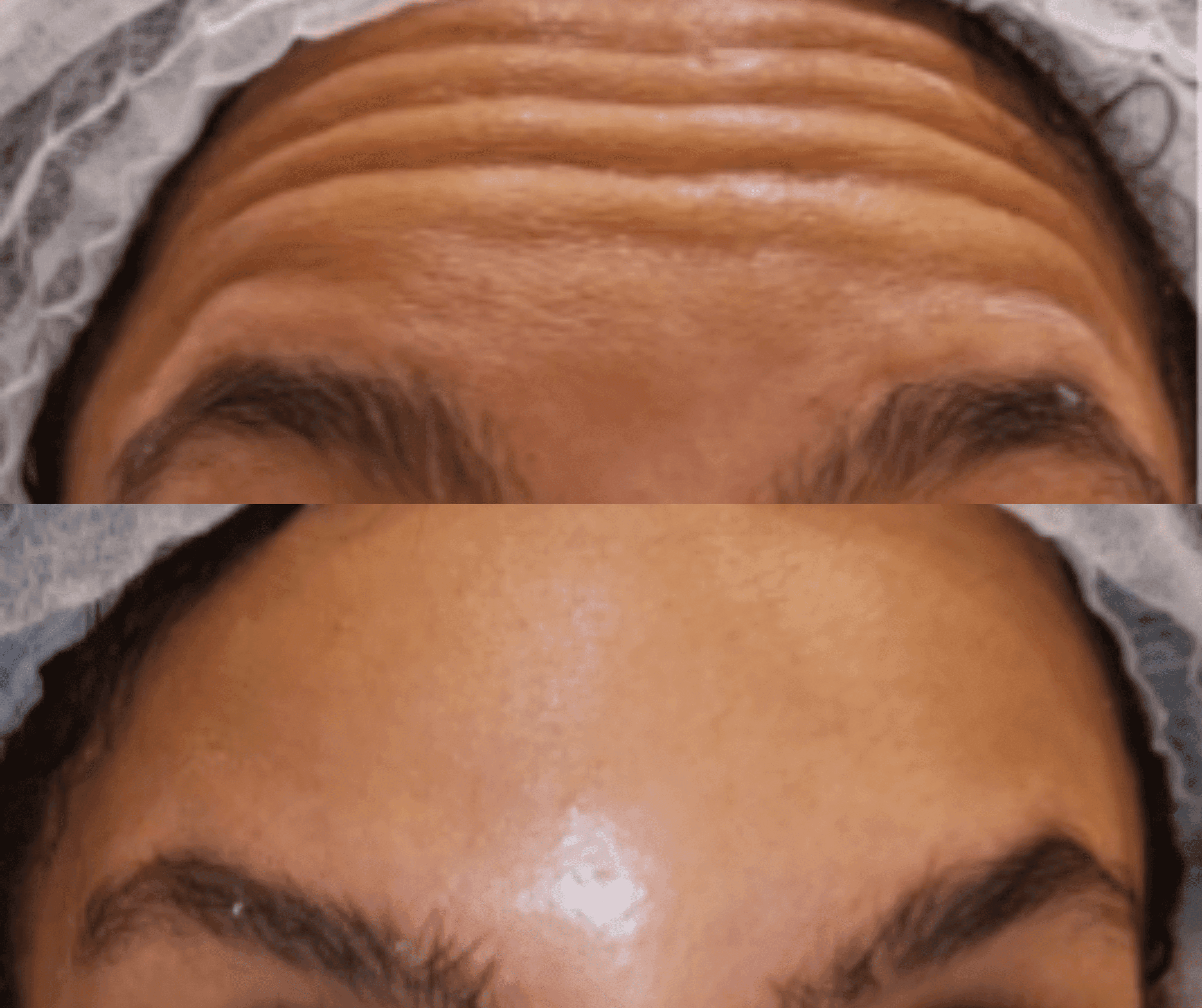 Before and After Wrinkle Tretment