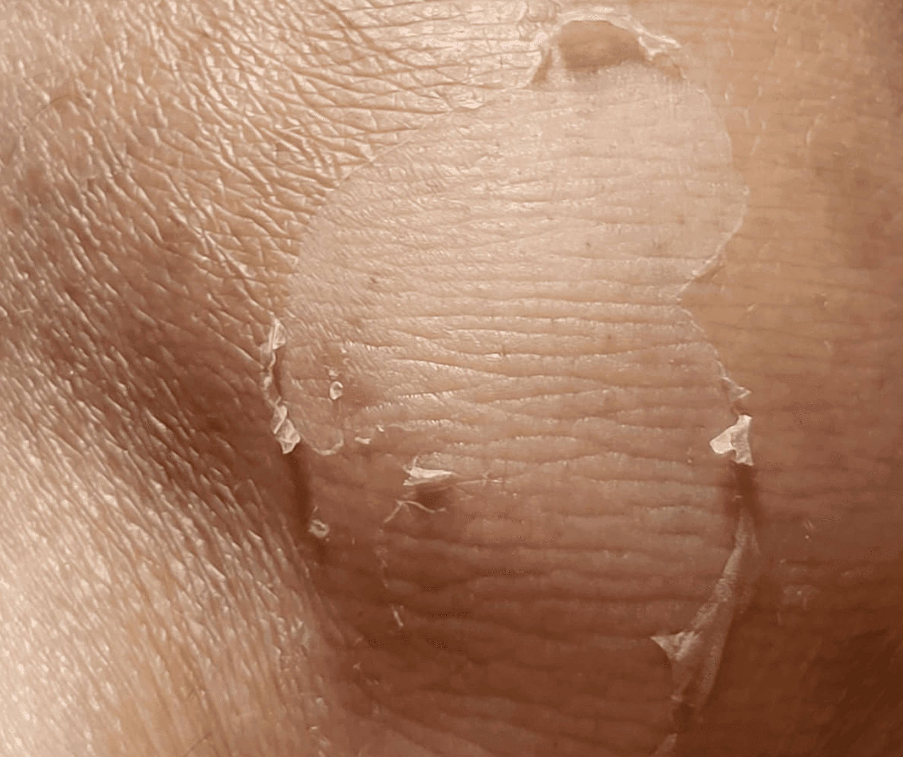 Before and After Cold Peel