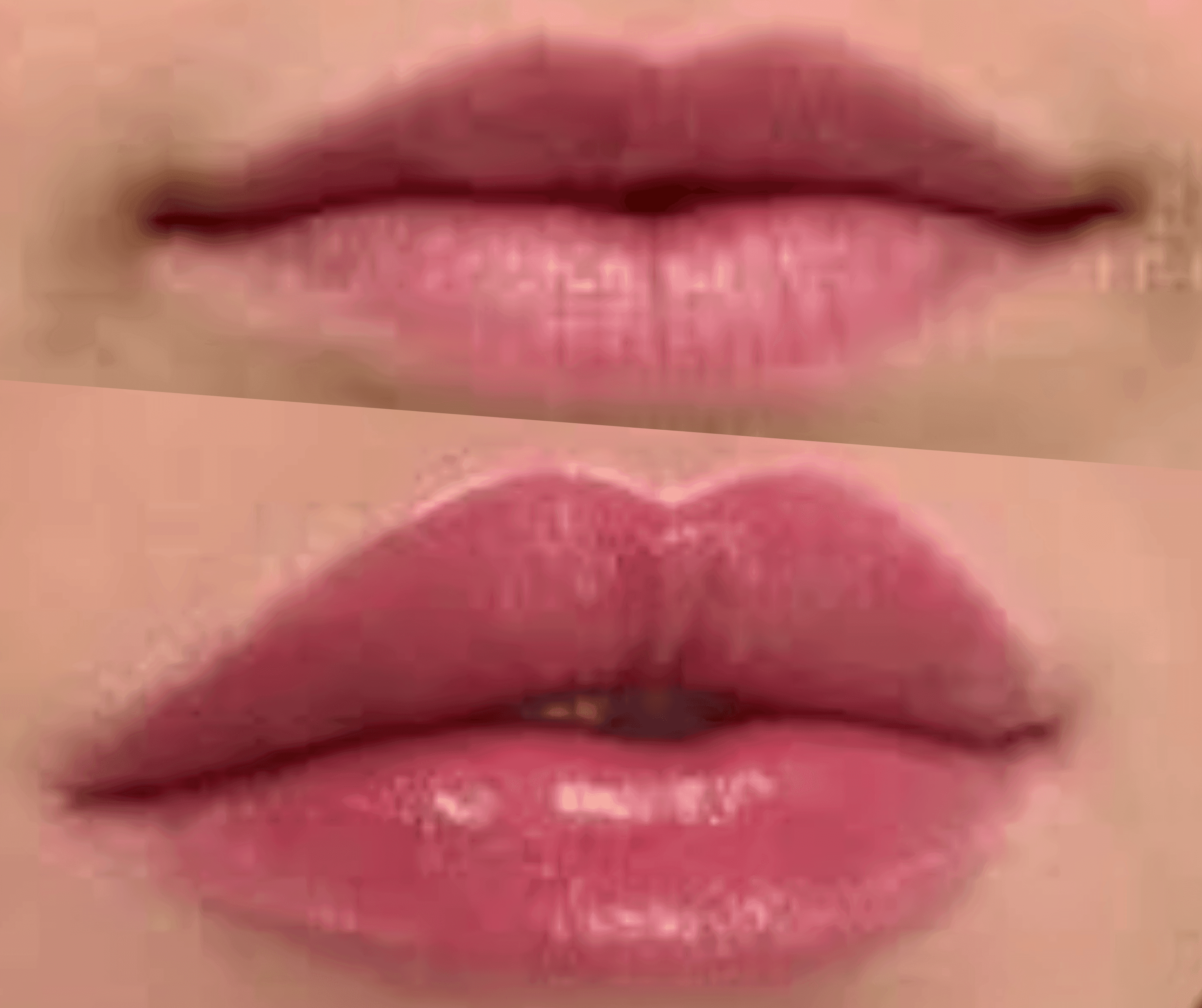 Before and After lip Filler