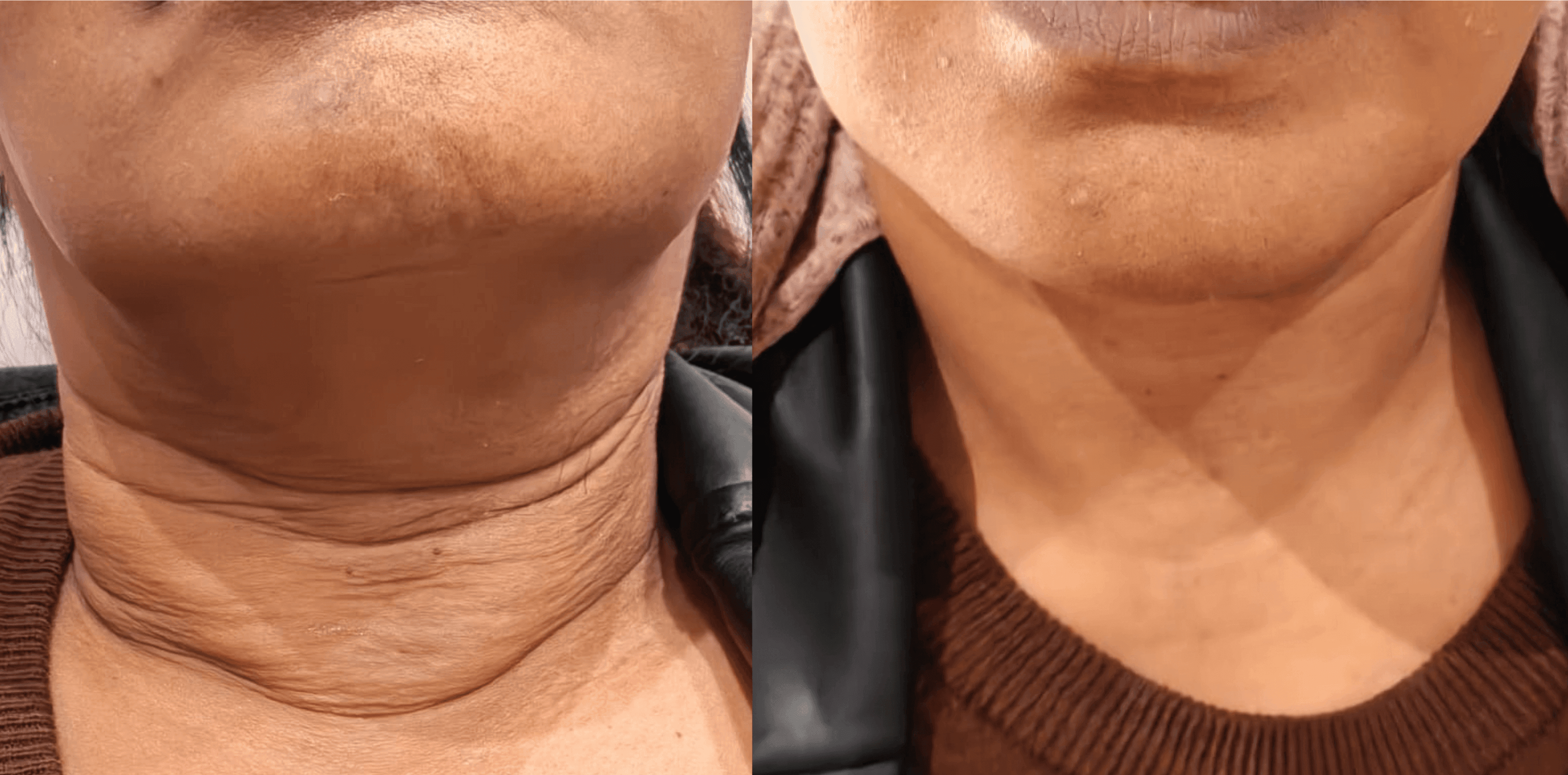 Before and After 4d Face Lift