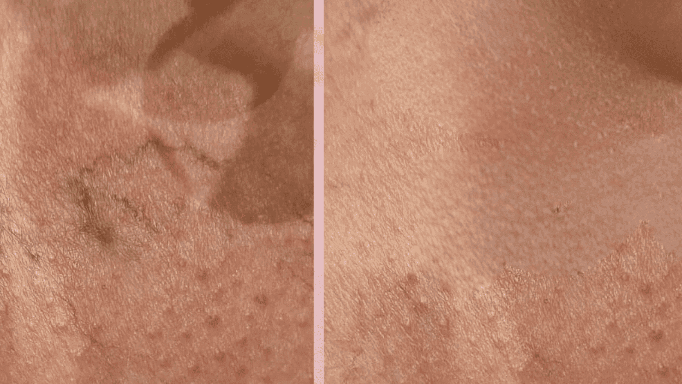 Before and After Vascular laser removal
