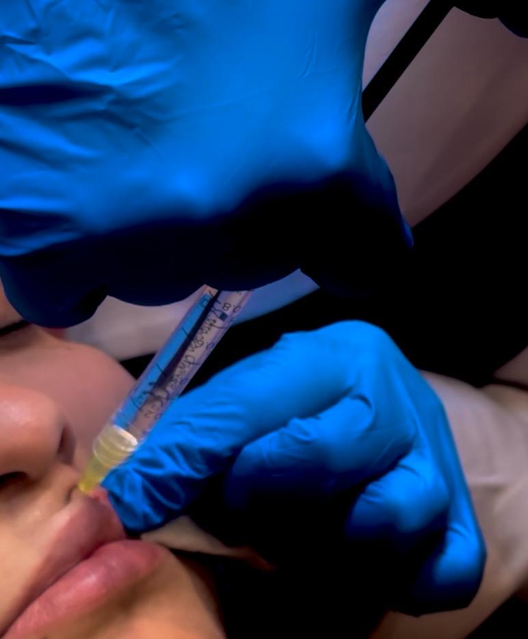 Fillers in New Cairo at Magenta Clinique