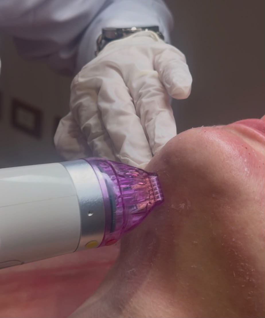 RF Microneedling in New Cairo at Magenta Clinique