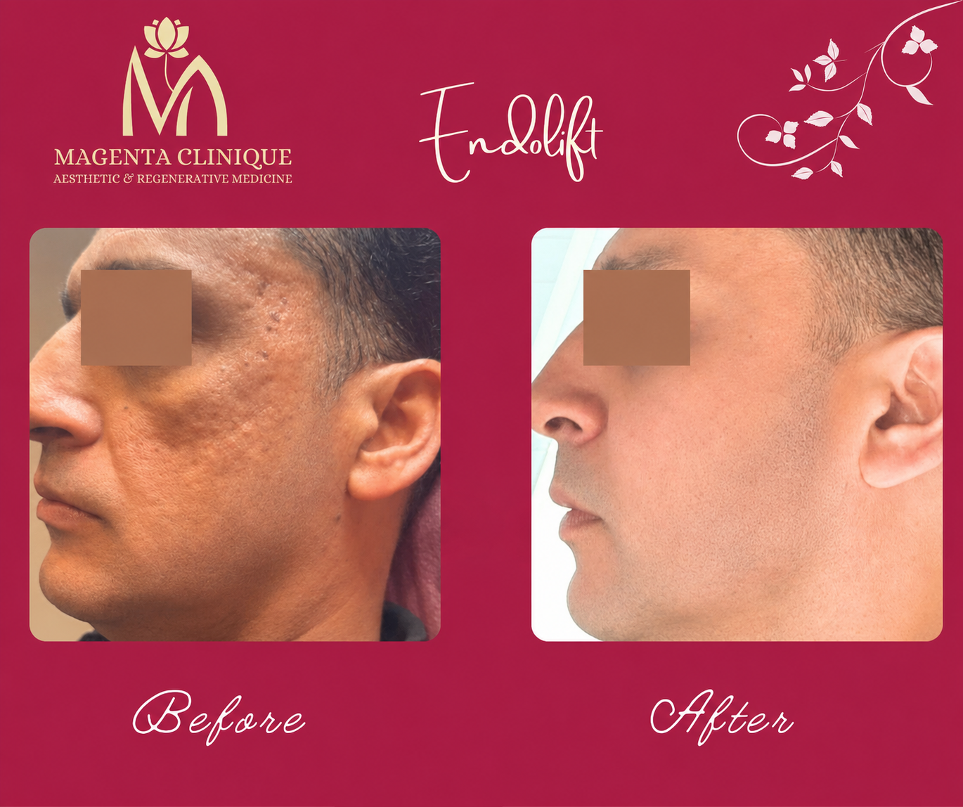 Endolift laser treatment planning for the jawline and lower face in Egypt