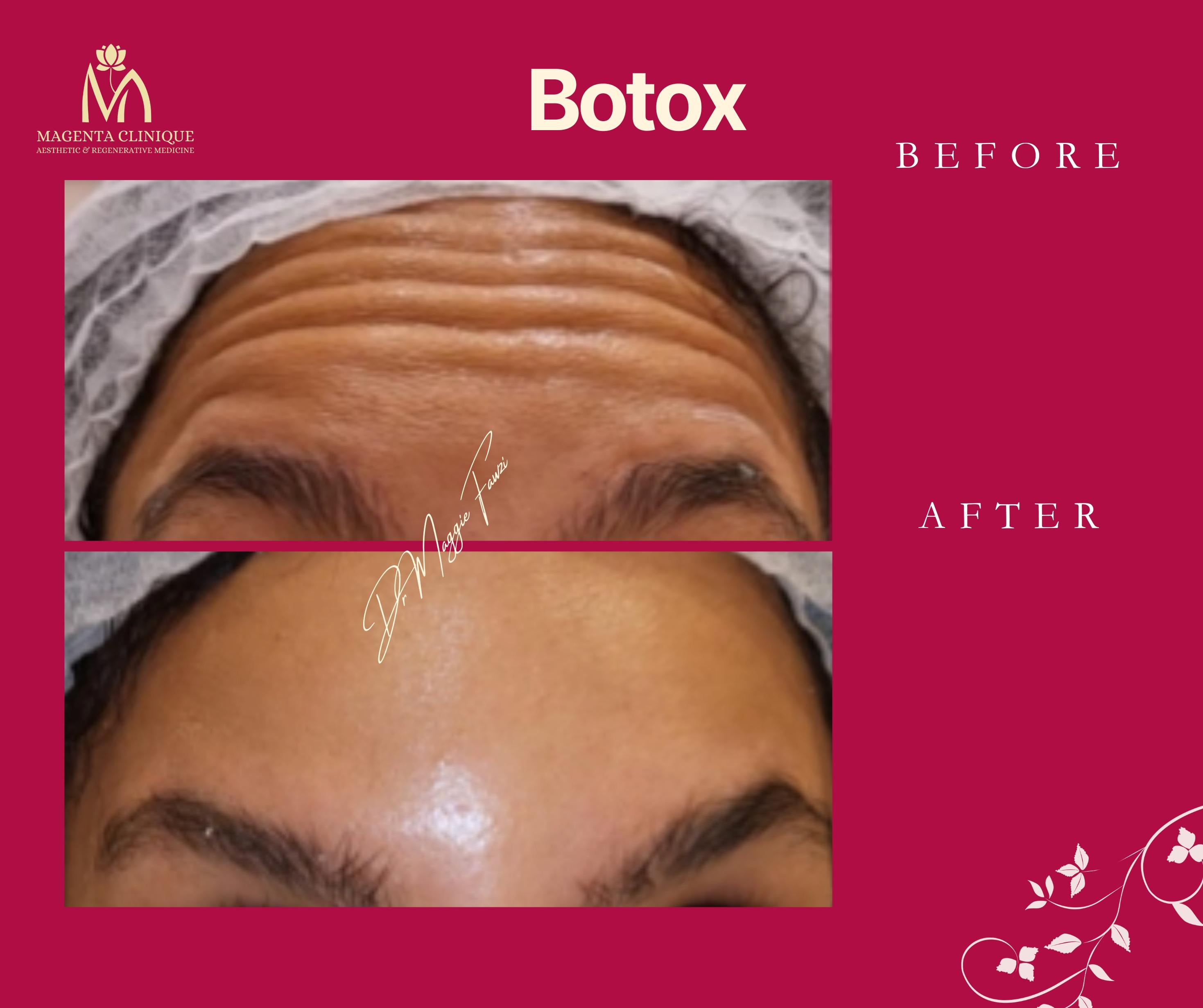 Botox Forehead Lines Before and After at Magenta Clinique Maadi