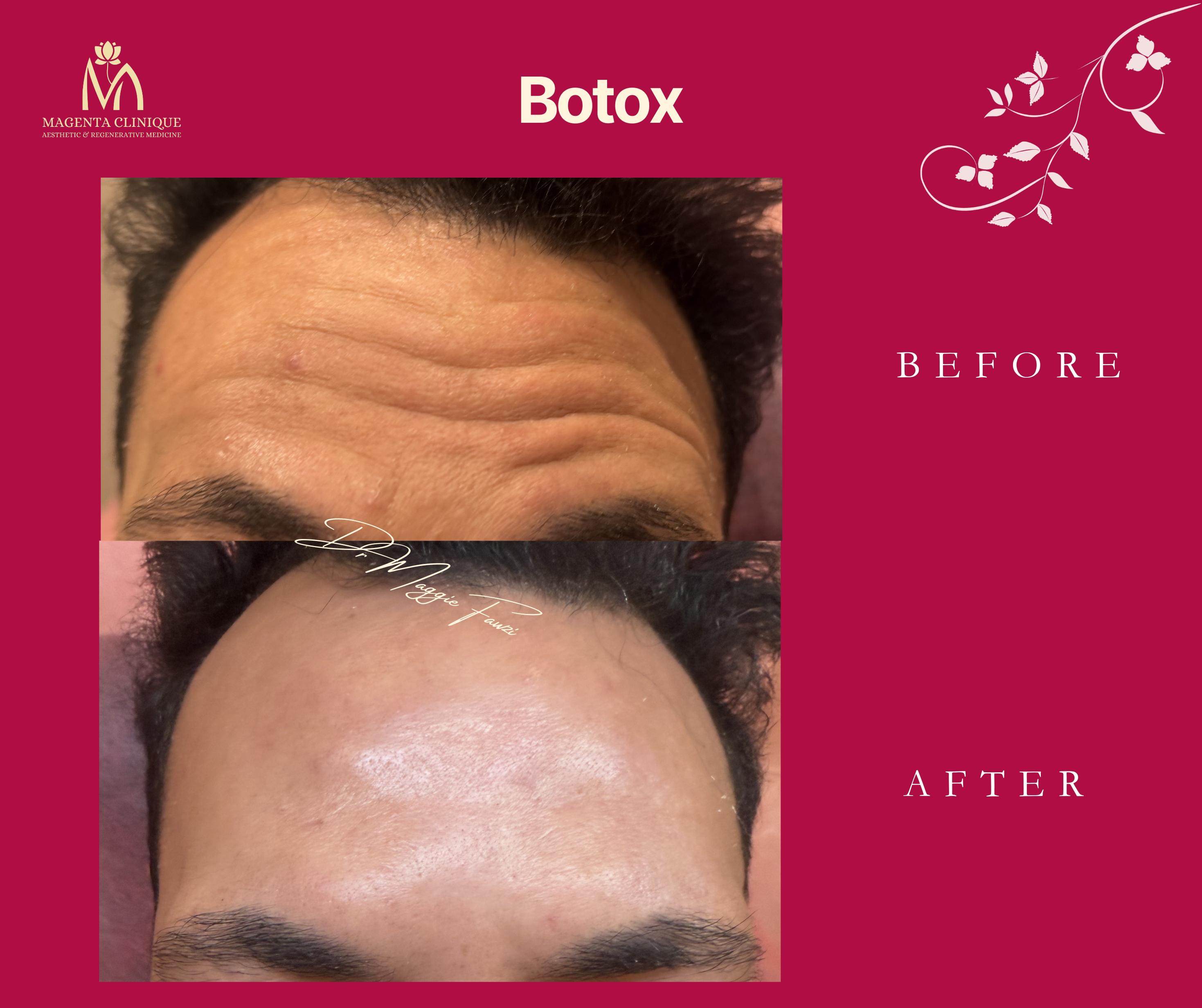 Botox Forehead Lines - Male Patient Before and After at Magenta Clinique Maadi