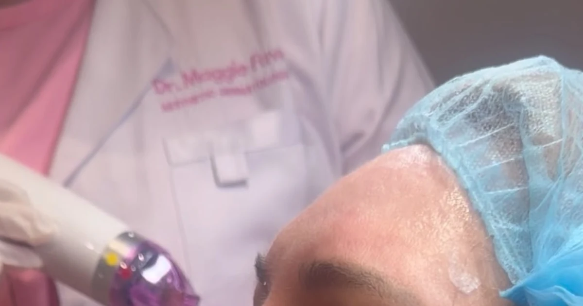 RF microneedling vs microneedling comparison showing an in-clinic skin procedure