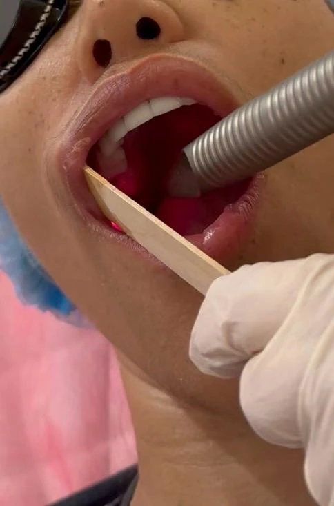 Fotona 4D intraoral laser stage used in a facial rejuvenation session